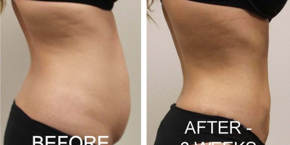 Liposuction is a type of surgery that is not appropriate for all people